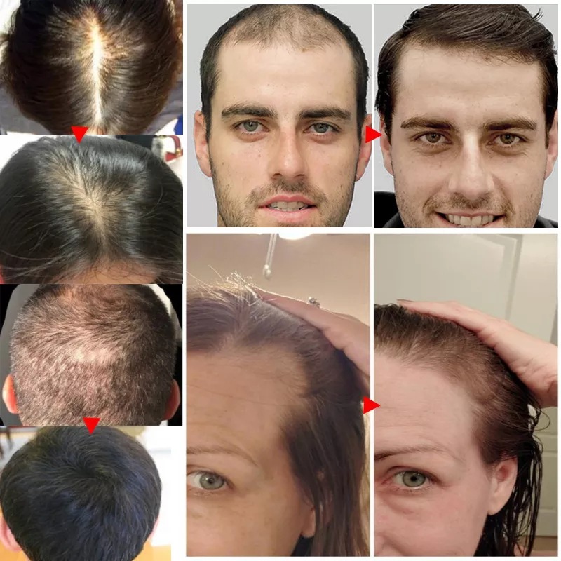 2023 بيوتين زيت نمو الشعر السر - مراجعة Licorice Root Sticks وسعره